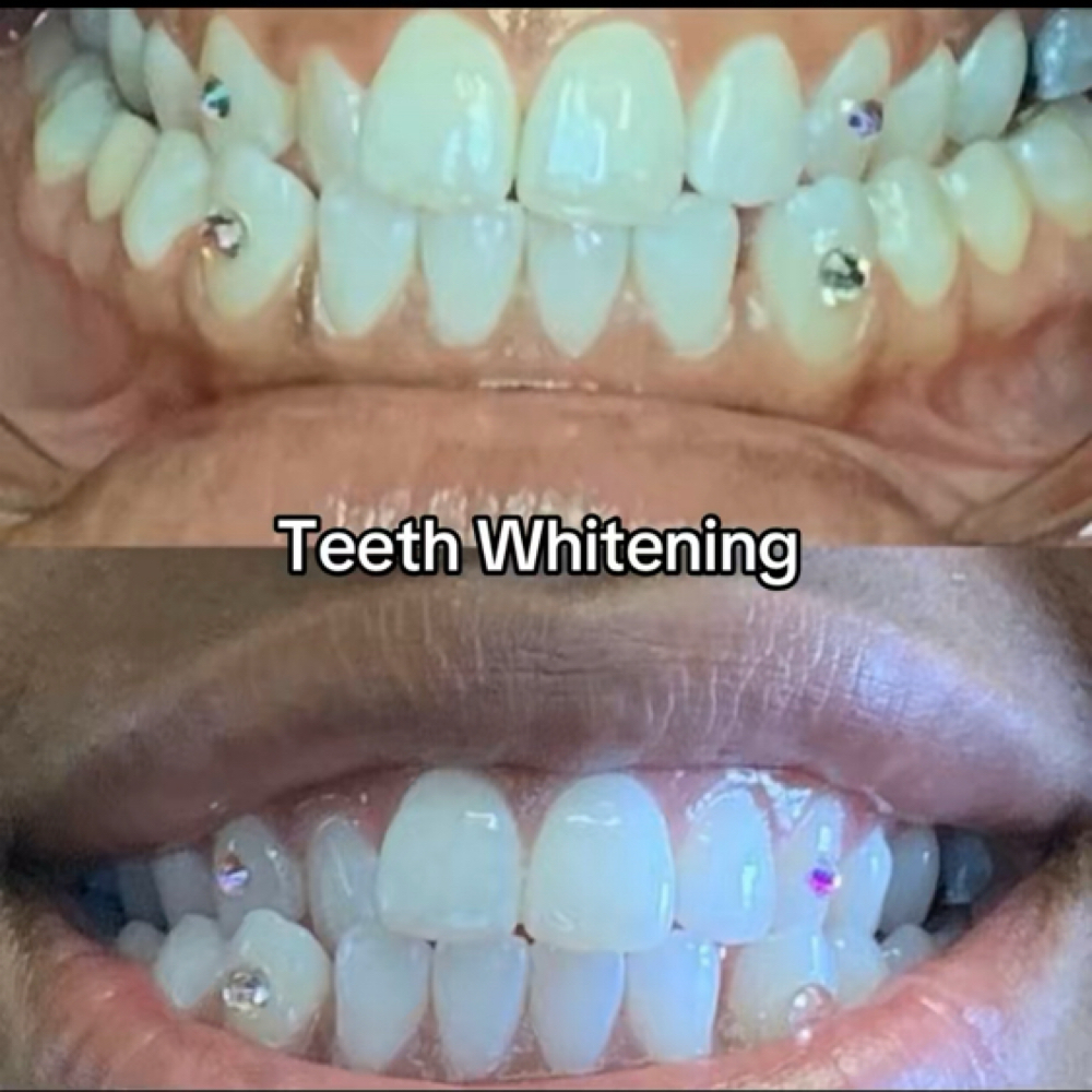 80 Min Teeth Whitening at KB Beauty Bar in Lake Elsinore, CA