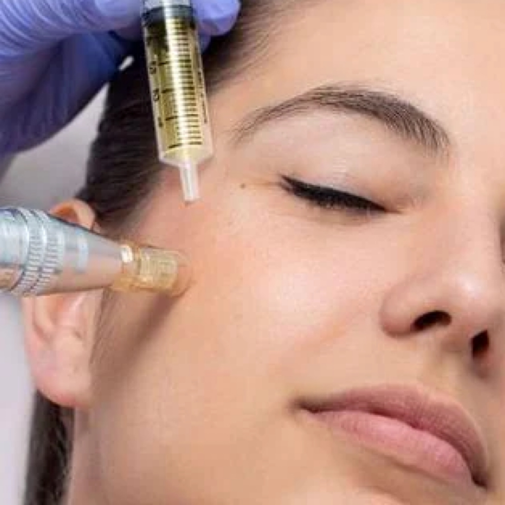 Undereye PDRN Microneedling at Arcana Med Spa in Castle Rock, CO