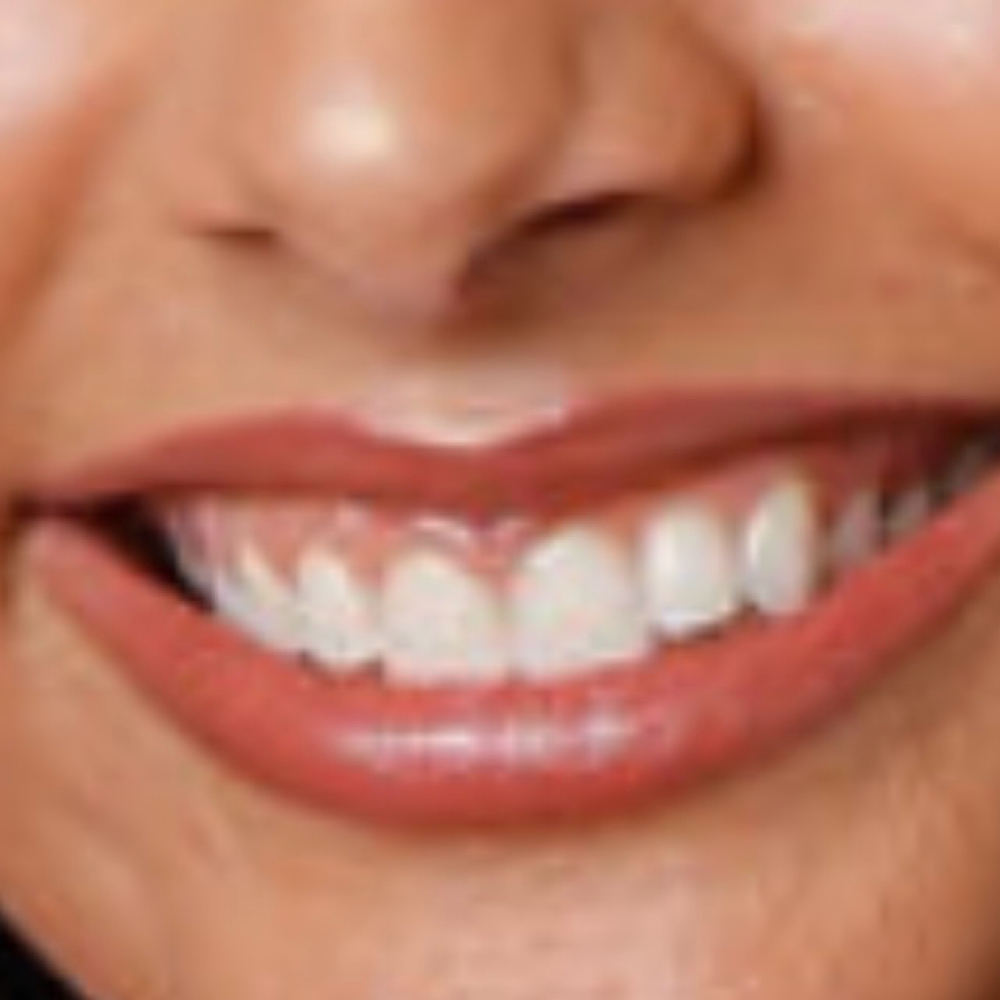 Cosmetic Teeth Whitening at 1k Beauty and Wellness in FRISCO, TX