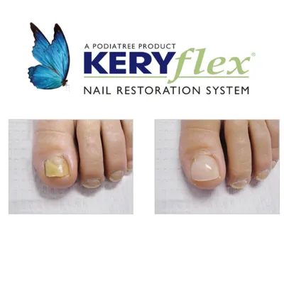 KeryFlex Toenail Reconstruction