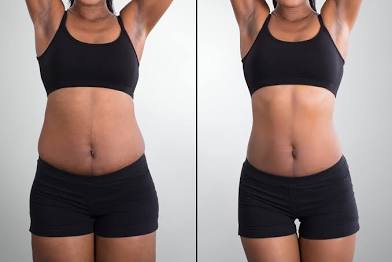 Non Surgical Laser Lipo