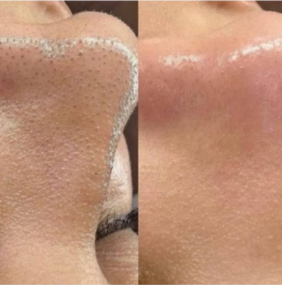 The Hydrofacial Edit