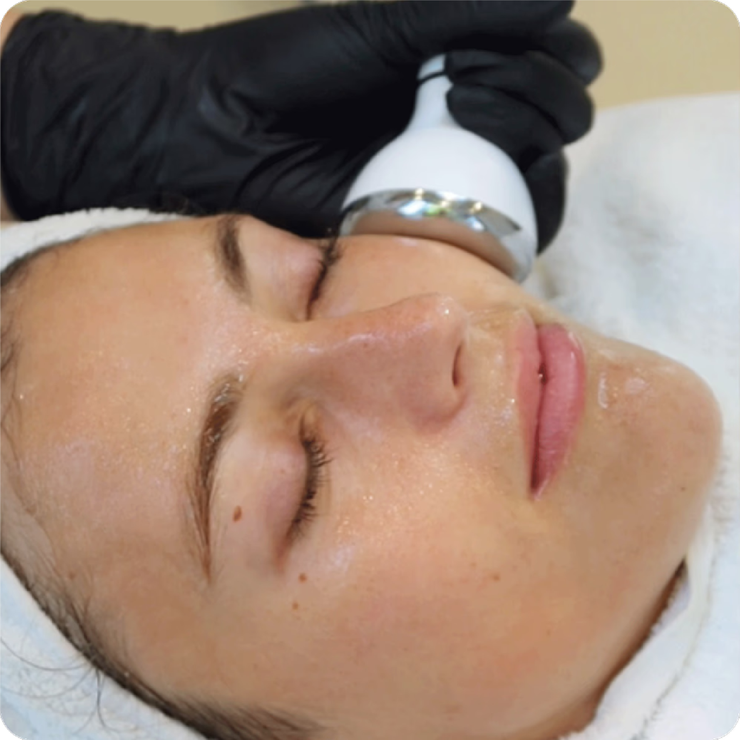 Cryo Face Lift