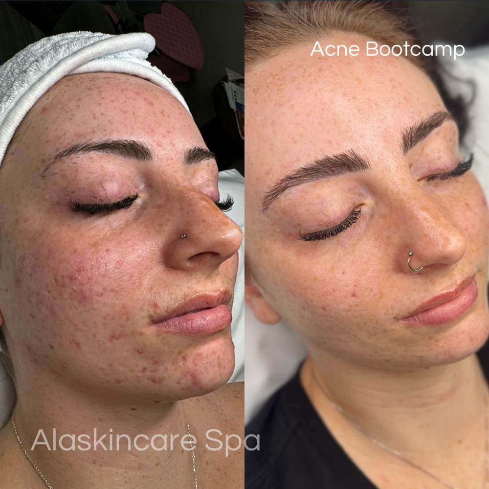 Acne Consultation + Treatment