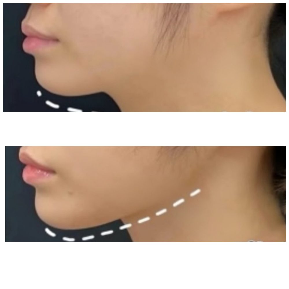 HiFu For Jawline And Chin