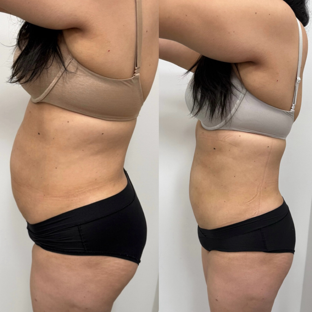 Body Sculpt Package at Estediva Aesthetics in Long Island City, NY