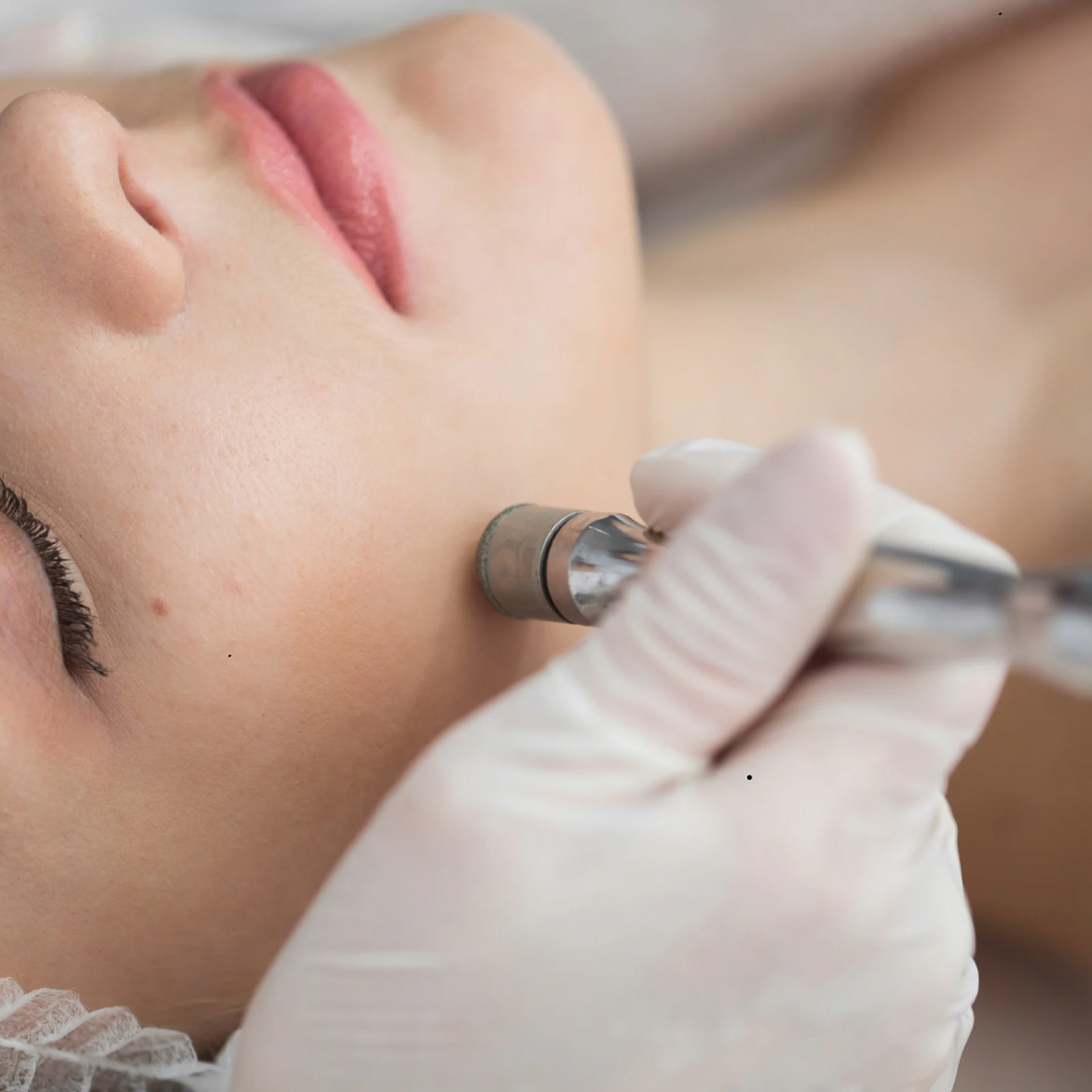 Microdermabrasion Facial at Rewind Med Spa in Longmont, CO