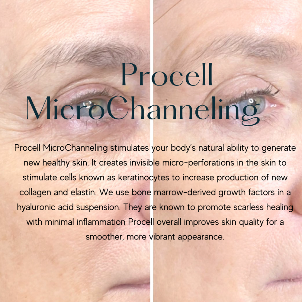 Procell Microchanneling