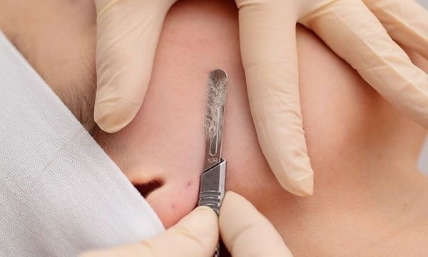 Dermaplane