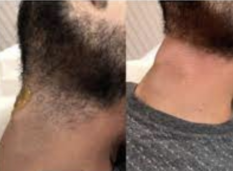 Neck Wax Men