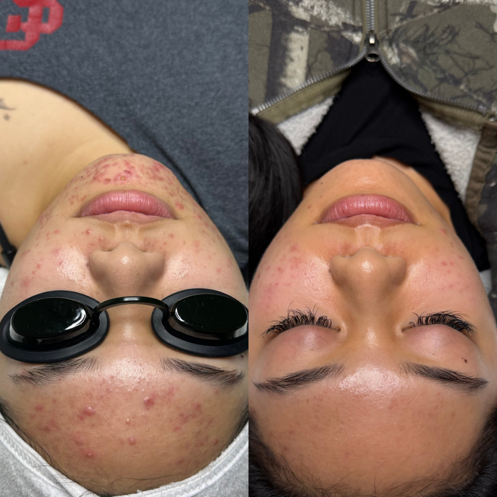 Clear Skin Program Treatment at Floraison Beauty in Vacaville, CA