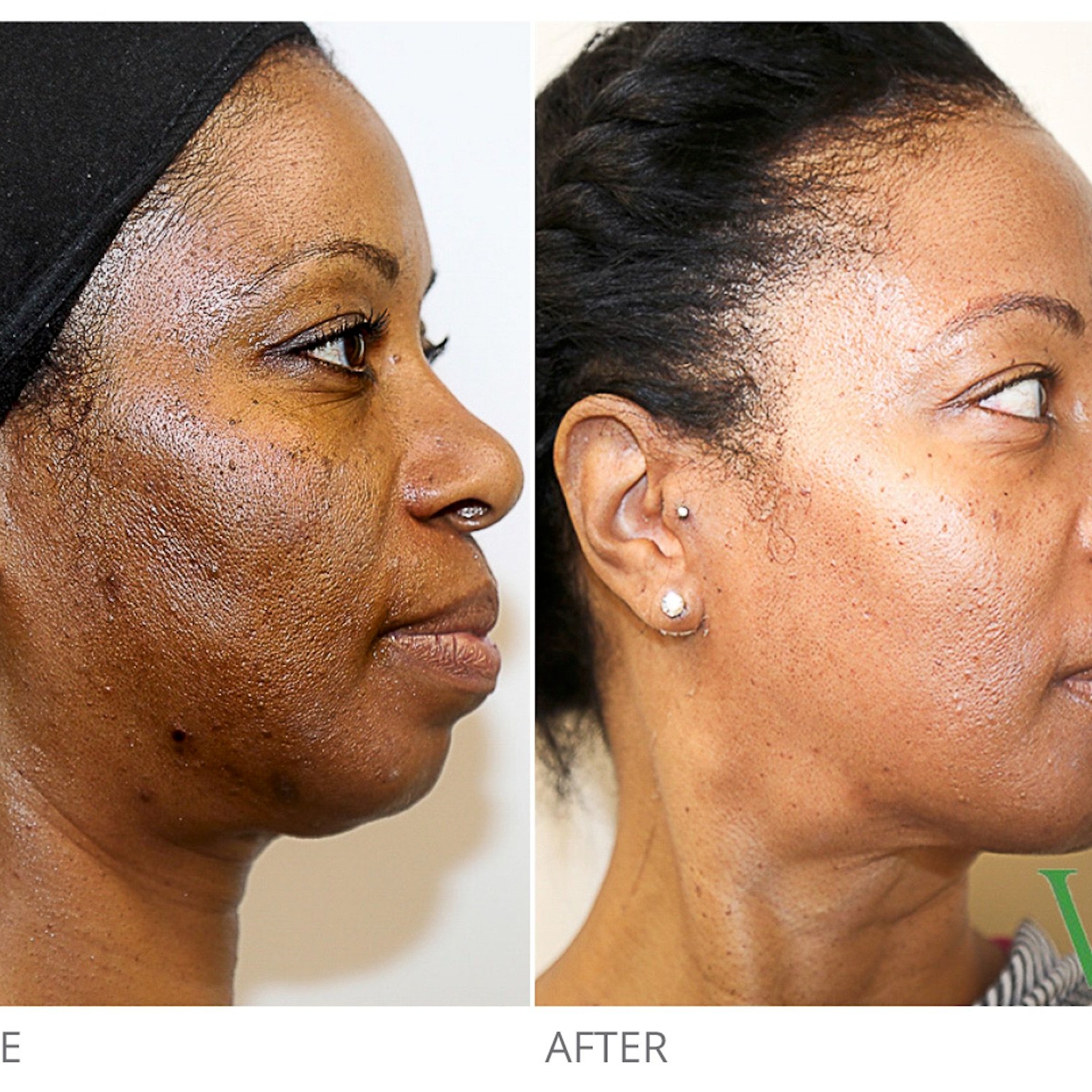 Medical Resurfacing Treatment