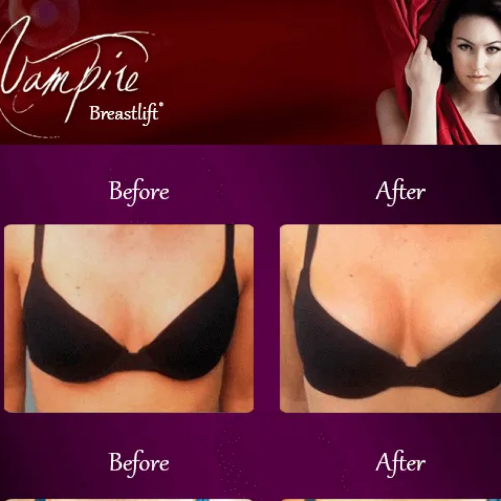Vampire Breast Lift at Reviva Wellness in Lake Ozark, MO