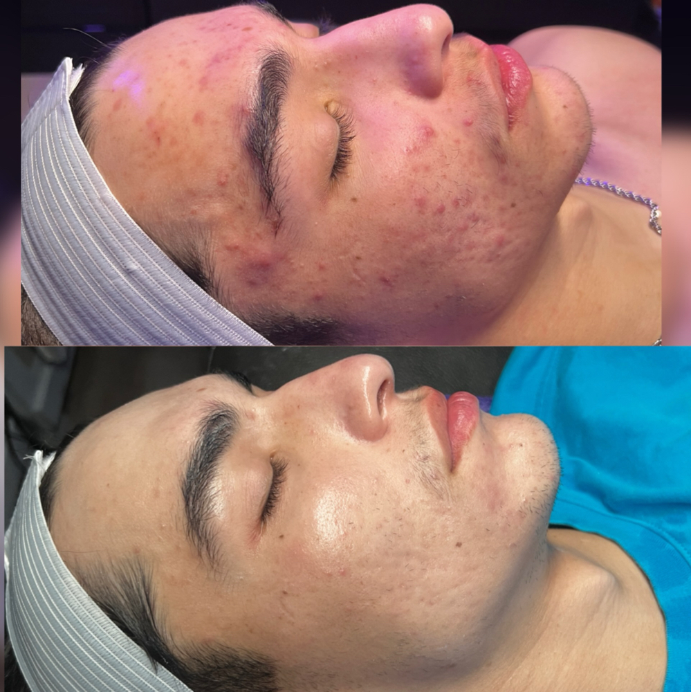 Acne Facial