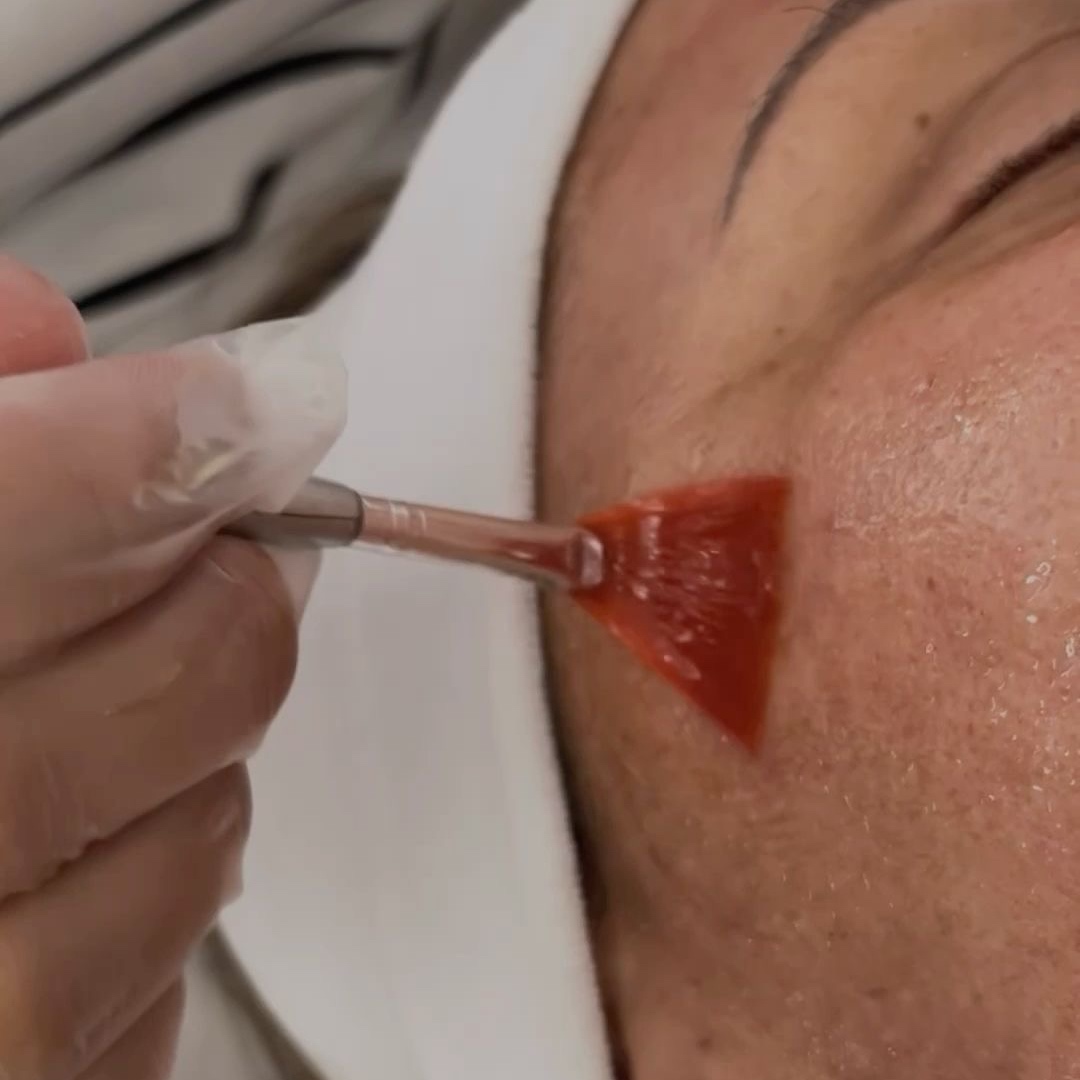 VI PEEL PRECISION at Remake Beauty Studio San Juan in San Juan, TX