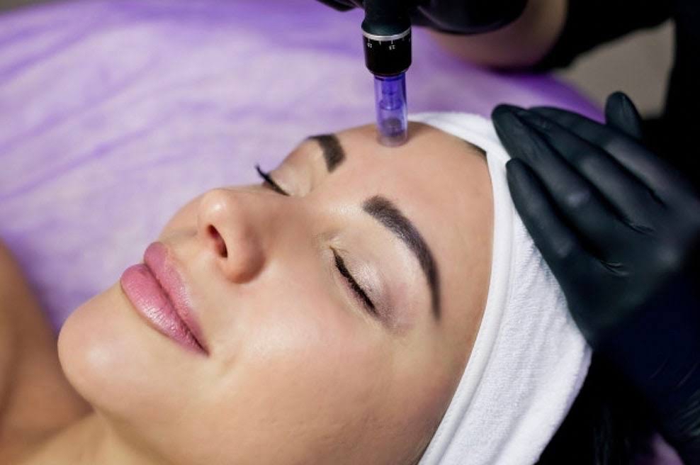 Microneedling Facial