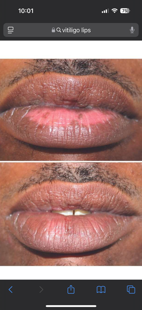 Paramedical Lip Re-Pigmentation