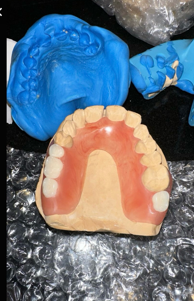 Acrylic Partial Denture