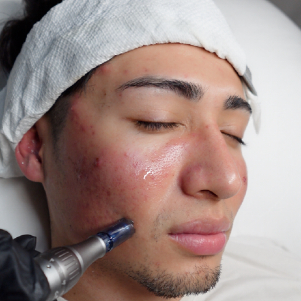 Microneedling / Dermapen at Nenusk Aesthetics in Long Island City, NY