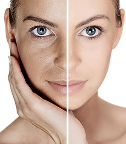 Chemical Peel (ADD ON)