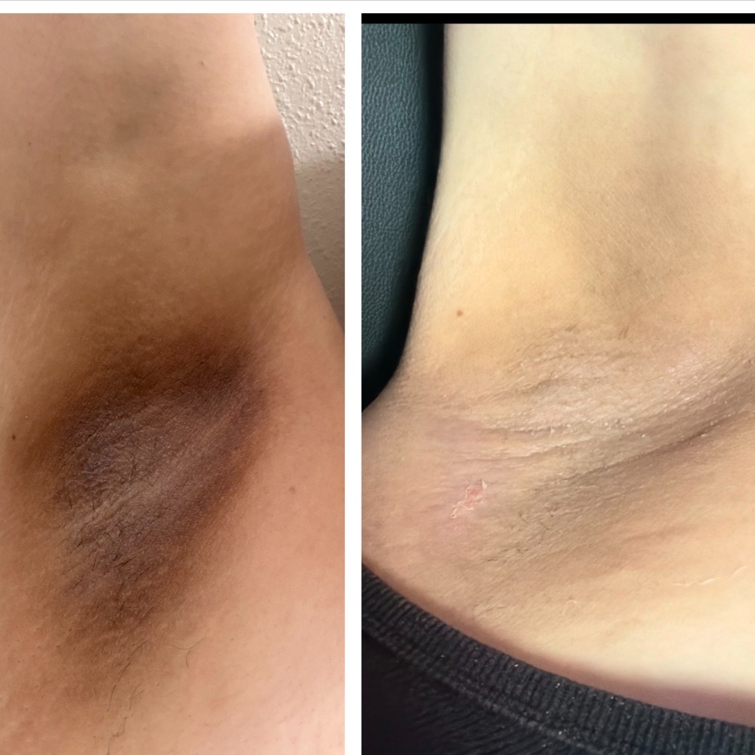 New | Underarm Brightening at Velnaira in Lakewood, CA