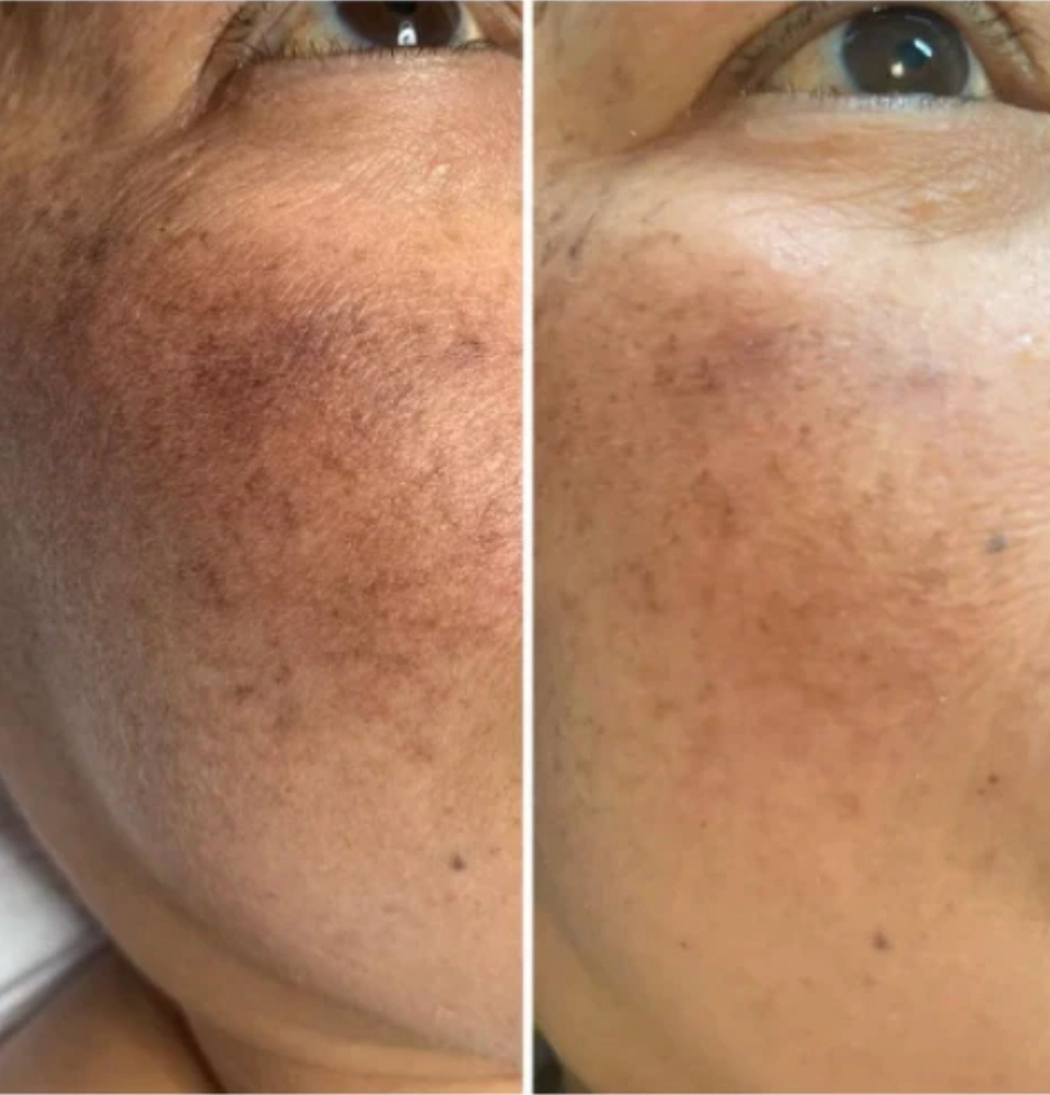 Intimate Bleaching- Face