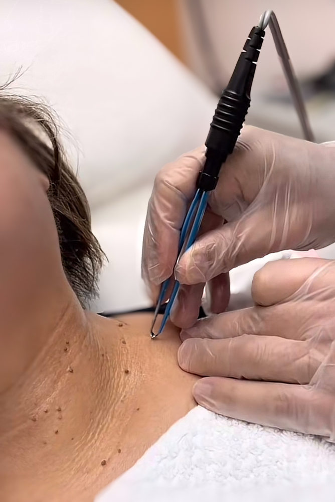 Skin Tag Removal at Zoraya Velez AESTHETICIAN in Richmond, VA
