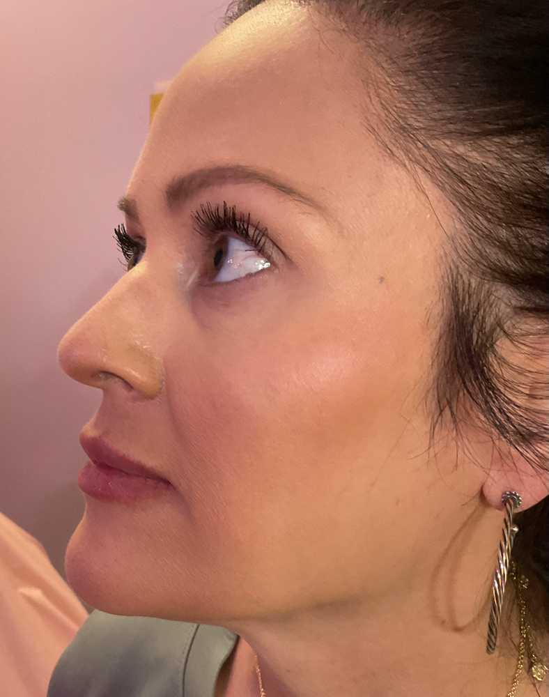 Facial Balancing Filler at Unveiled Beauty Aesthetic Studio in Converse, TX