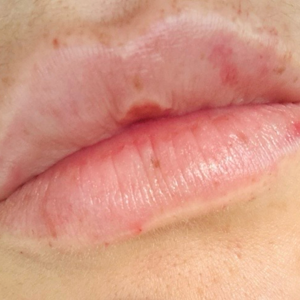 Lip Filler- Half Syringe at Drip & Glow - By Ciera, RN