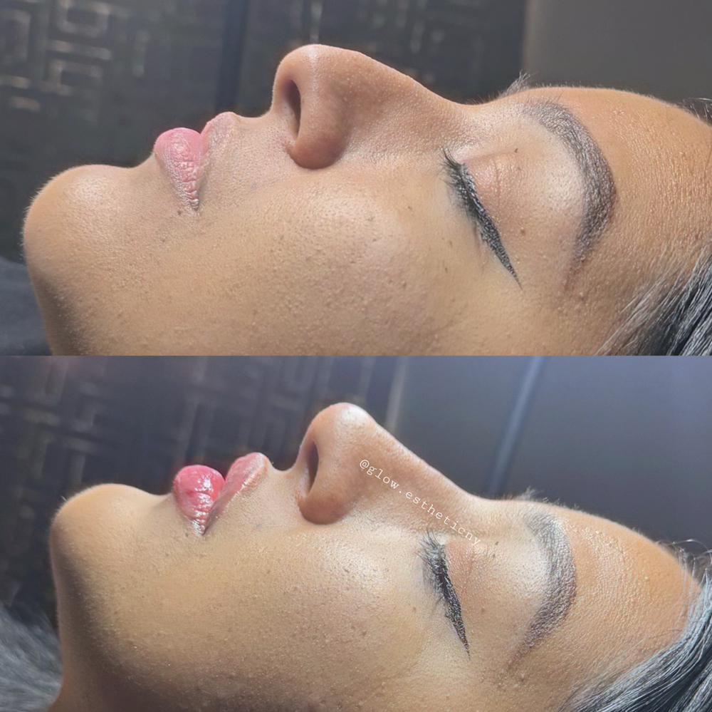 Rhinomodelation Hyaluronic acid