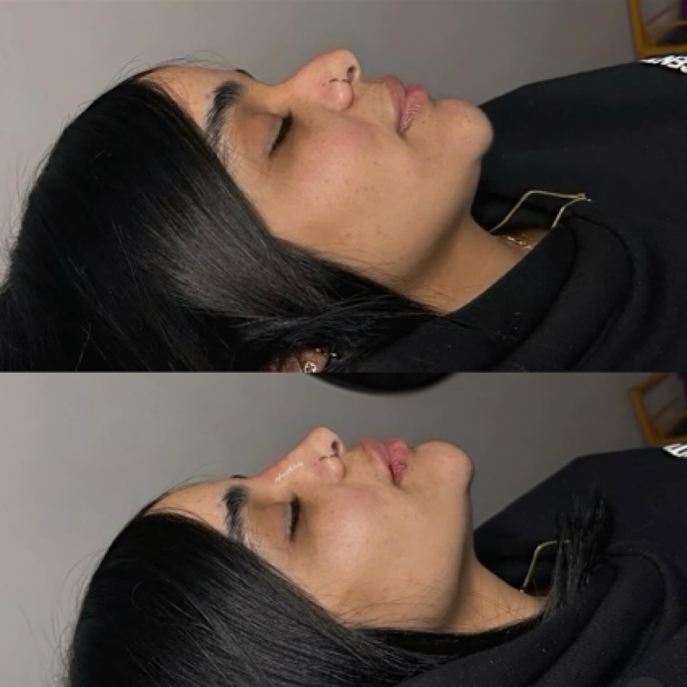 Rhinomodelation Hyaluronic acid at Glow Esthetic NY in Buffalo, NY