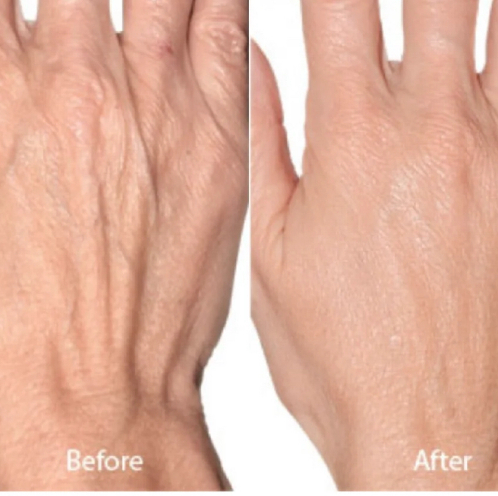PRP (Platelet-Rich-Plasma) HANDS at Allure Aesthetics & Wellness Studio in Midwest City, OK
