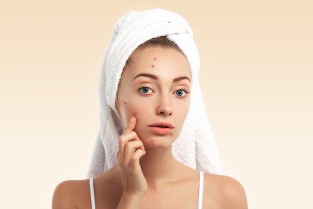 Acne Bootcamp