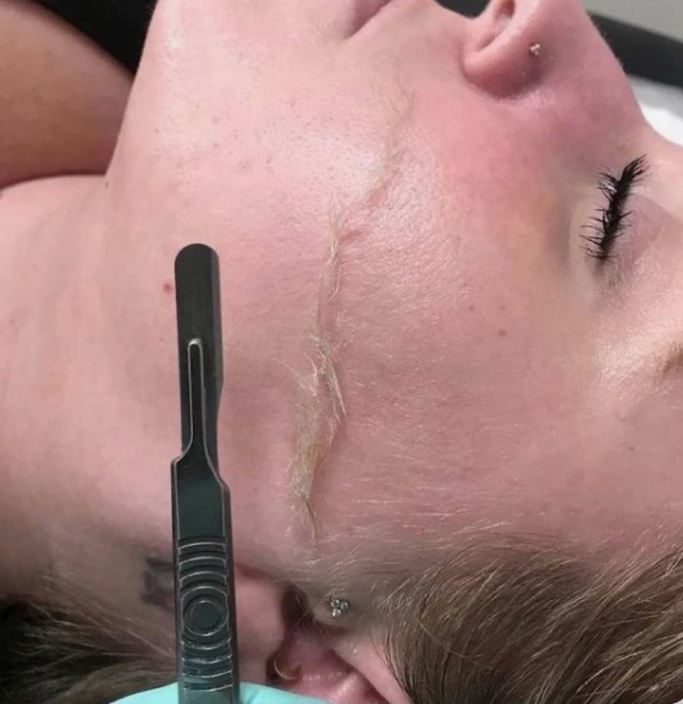 Dermaplane Facial