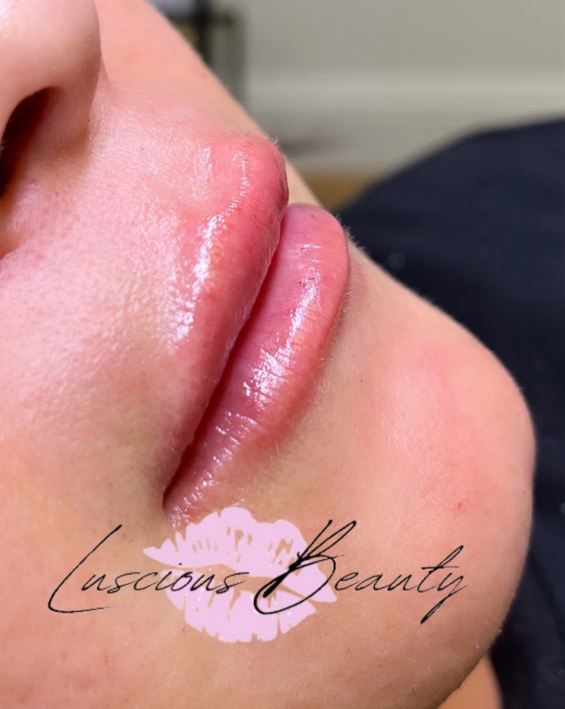 0.5 ML HYALURONIC ACID LIP FILLER