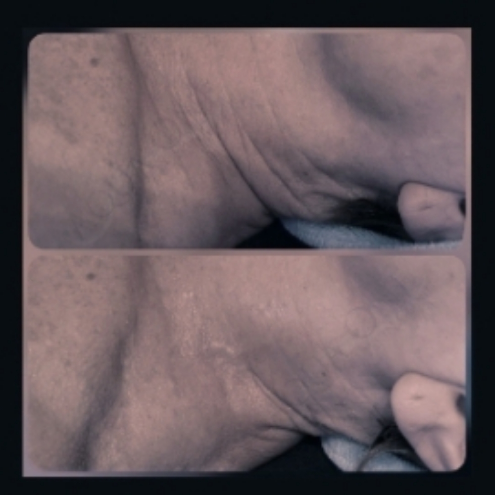 ADD-ON Neck Tx Ultra Lift at Aqua One Skin Clinic in Jasper, IN