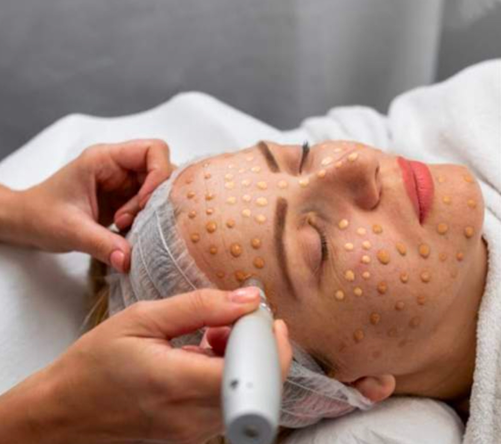 BB Glow With Microneedling at Le Rose beauty Ave in Bronx, NY
