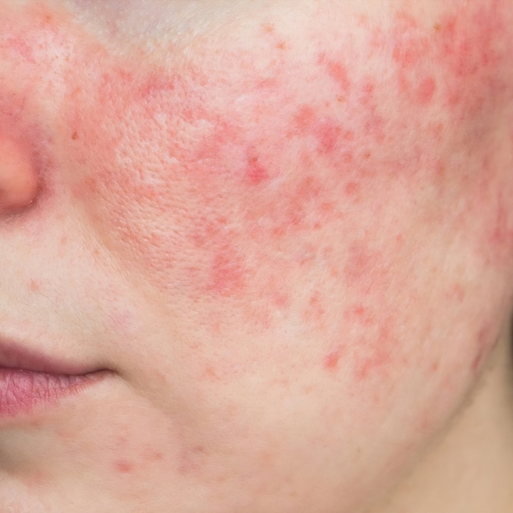 Sensitive Skin + Rosacea Facial at Crystalyn Couture 👑 Salon & Spa in Surprise, AZ