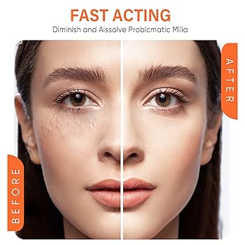 Milia Removal Treatment