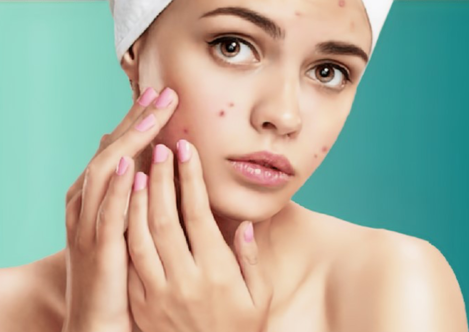 Acne Treatment/Tratamiento de Acne