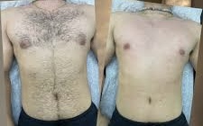 Waxing - Chest & Stomach