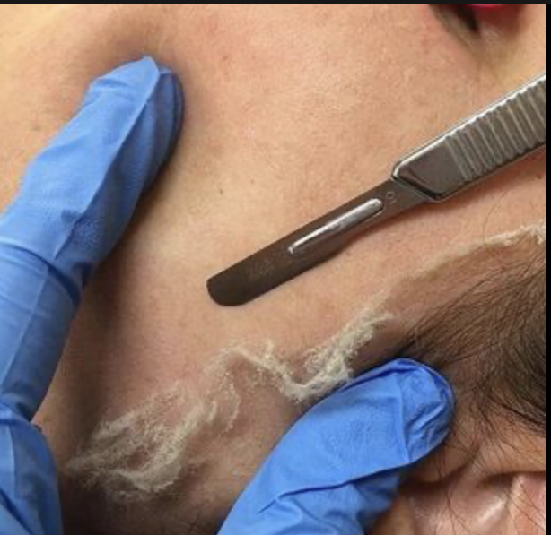 Dermaplane facial