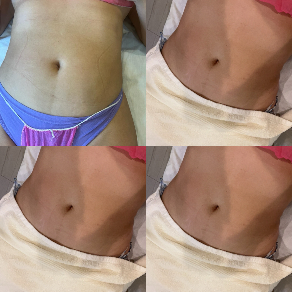 Non Invasive Body Contour One Sessi at 321 skin club LLC in Melbourne, FL