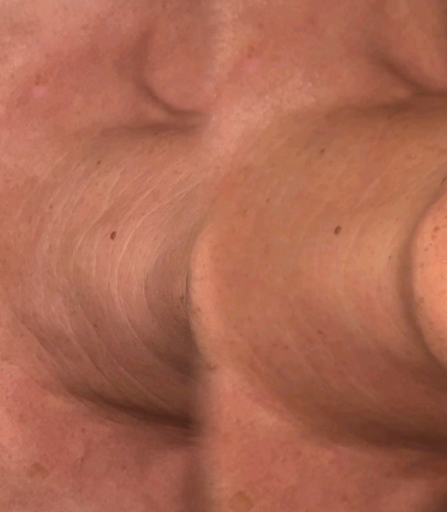 Neck And Decolletage Extension.