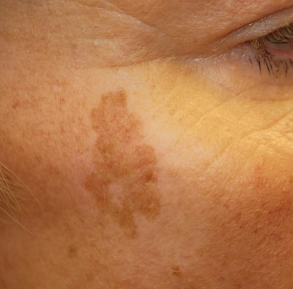 Age Spot Removal W/Facial