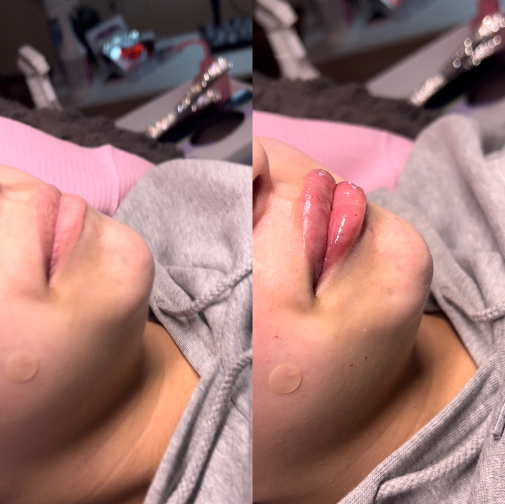 Lip Infusion
