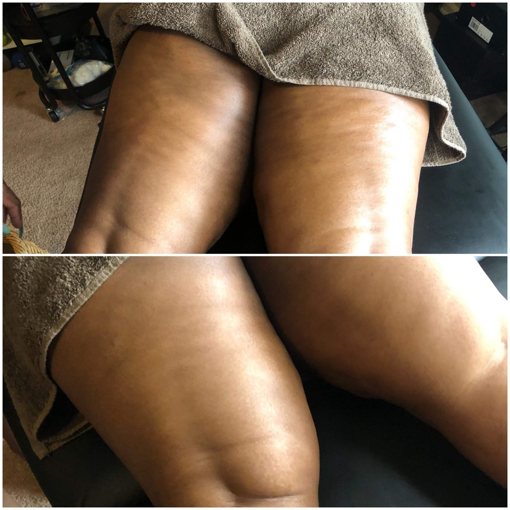 Cellulite Reduction Wood Therapy