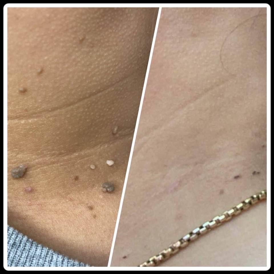 Skin Tags/moles Remove