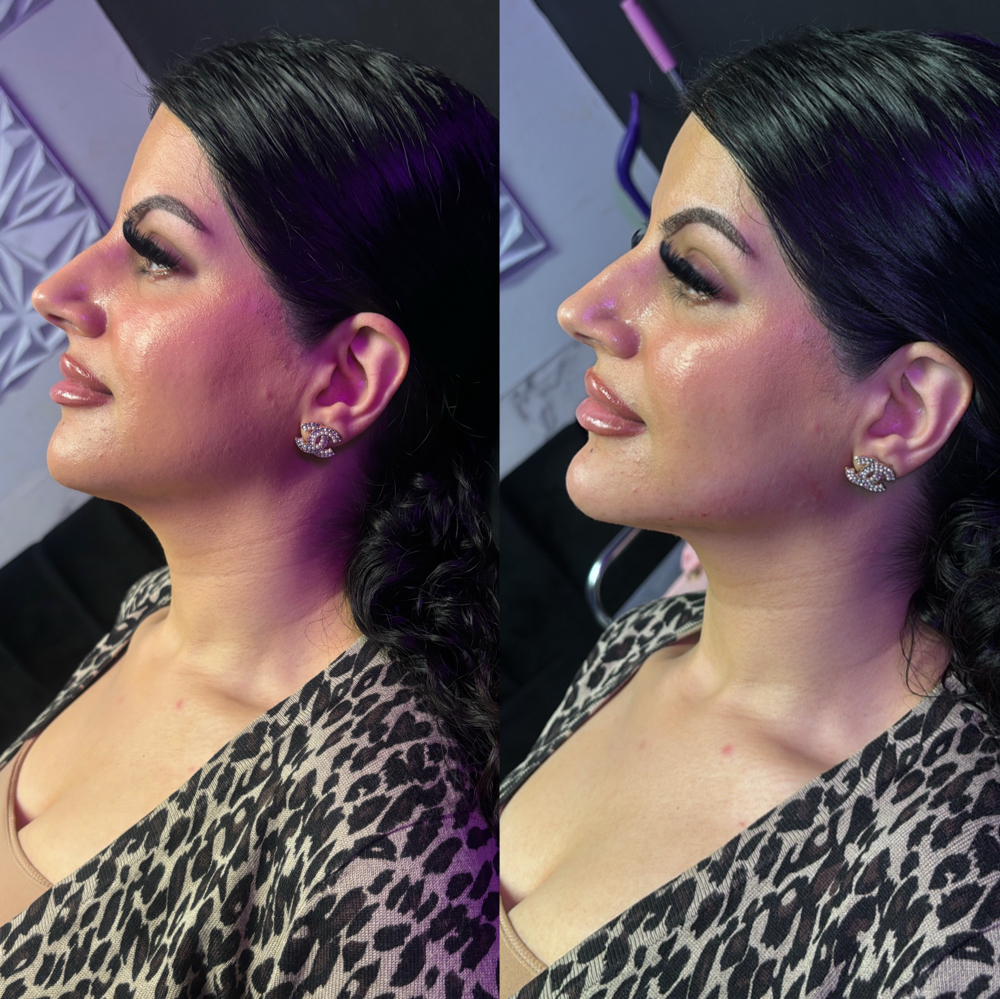 Chin Filler at Perfection Injections in Euless, TX