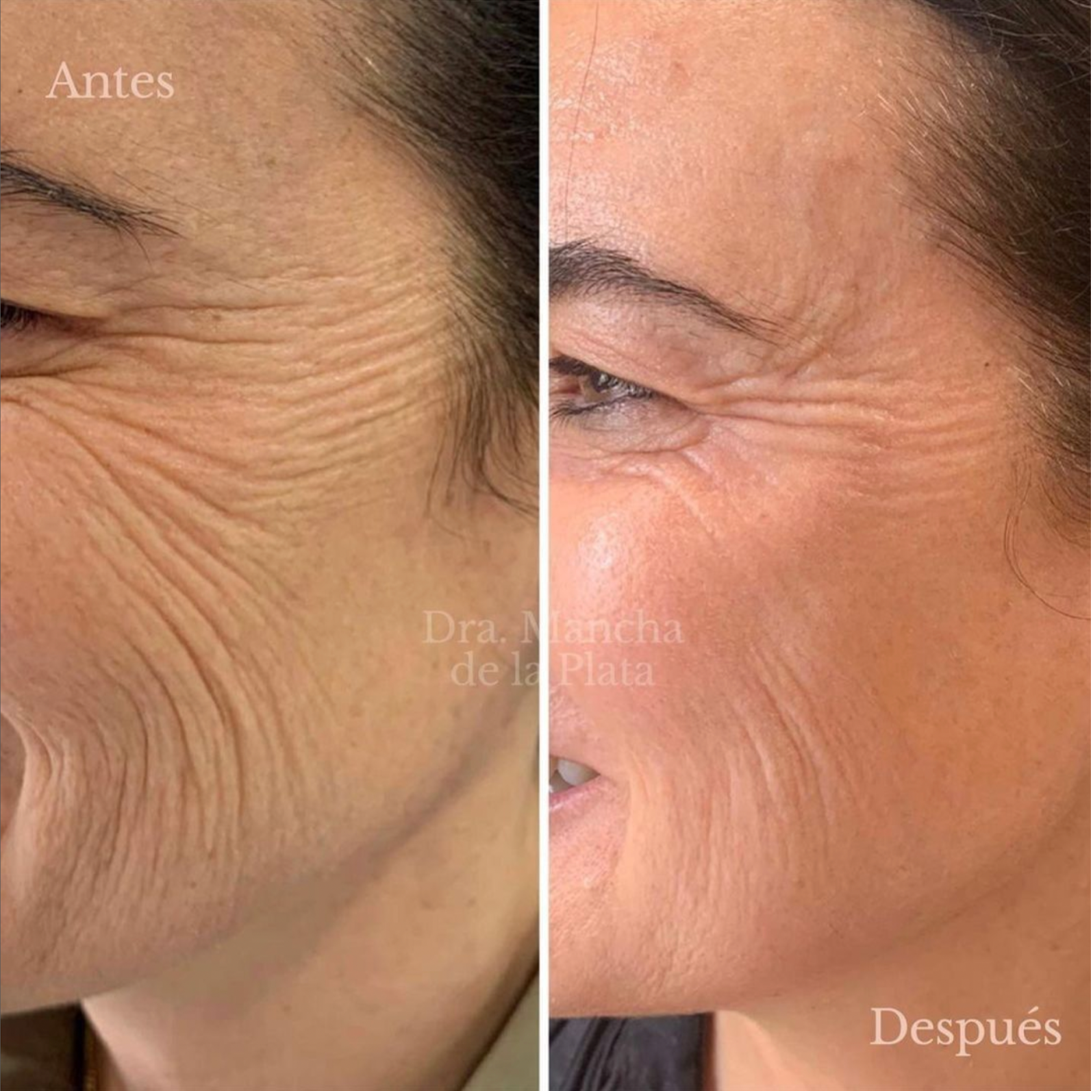 NeoSkin Rejuvenation at Skin 4 Glow Inc in MOHEGAN LAKE, NY
